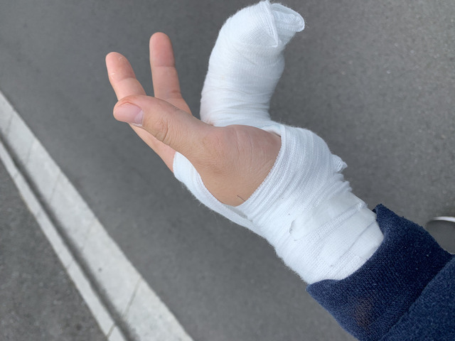 ブログ　指の怪我の写真　